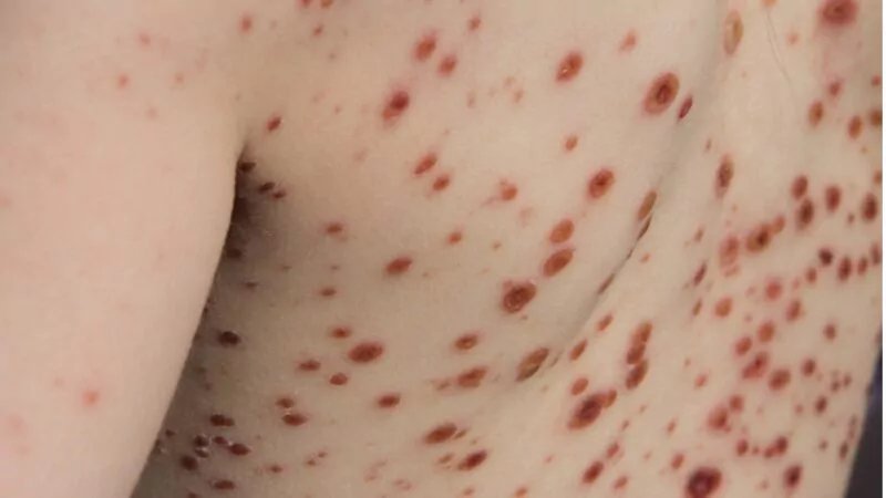 Chickenpox Cluster at Clarevue Psychiatric Hospital Contained, Ministry Says